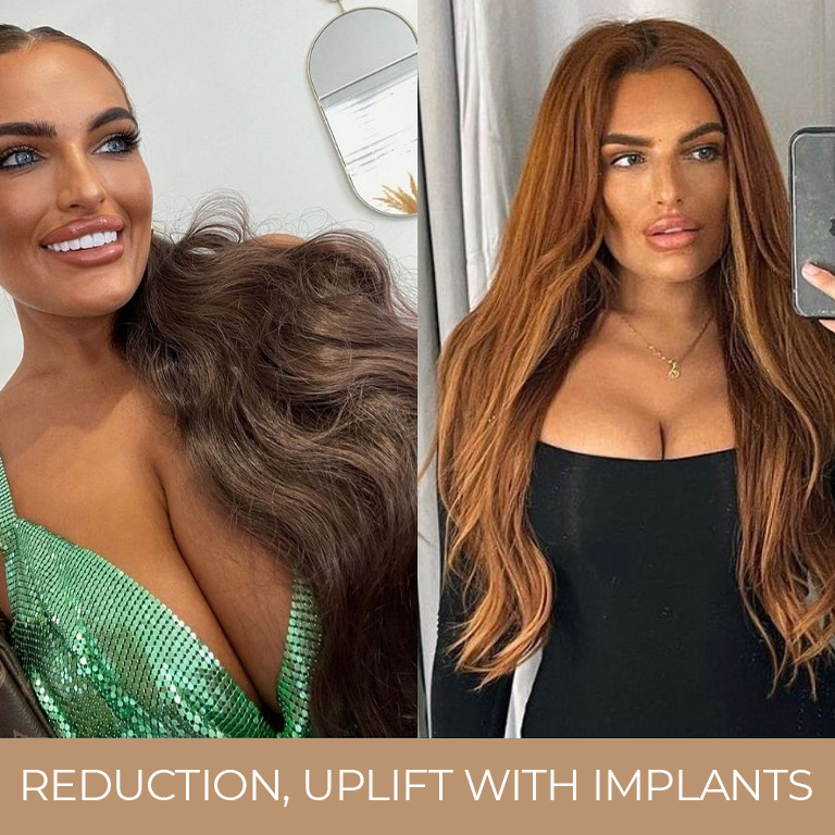 Breast Reduction with Implants