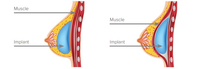 Labelled diagram showing the different placement of breast implants under the muscle and over the muscle