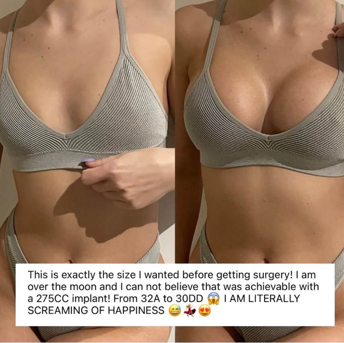 Comparing CC's to Bra Cup Size: How to Choose the Breast Implants Right for  You