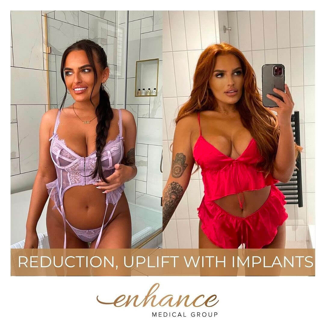 Breast reduction, Uplift with implants