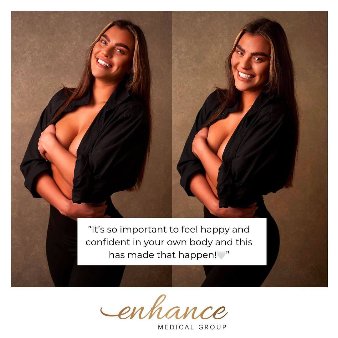 Enhance Medical UK - Amazing Before & After by Mr Maklad 🤍 “I was  previously a 32a and now a 32e. Results are now 3 weeks post op and very  happy with