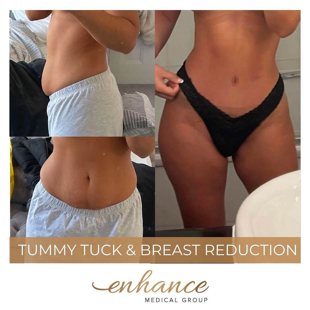Tummy Tuck with Muscle Repair