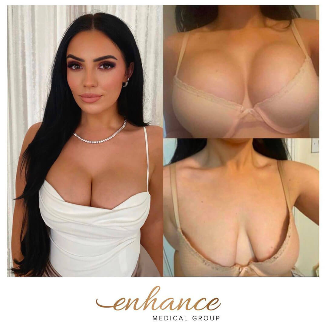 Breast Implants Under the Muscle vs Over: What's the Difference? - Harley  Clinic