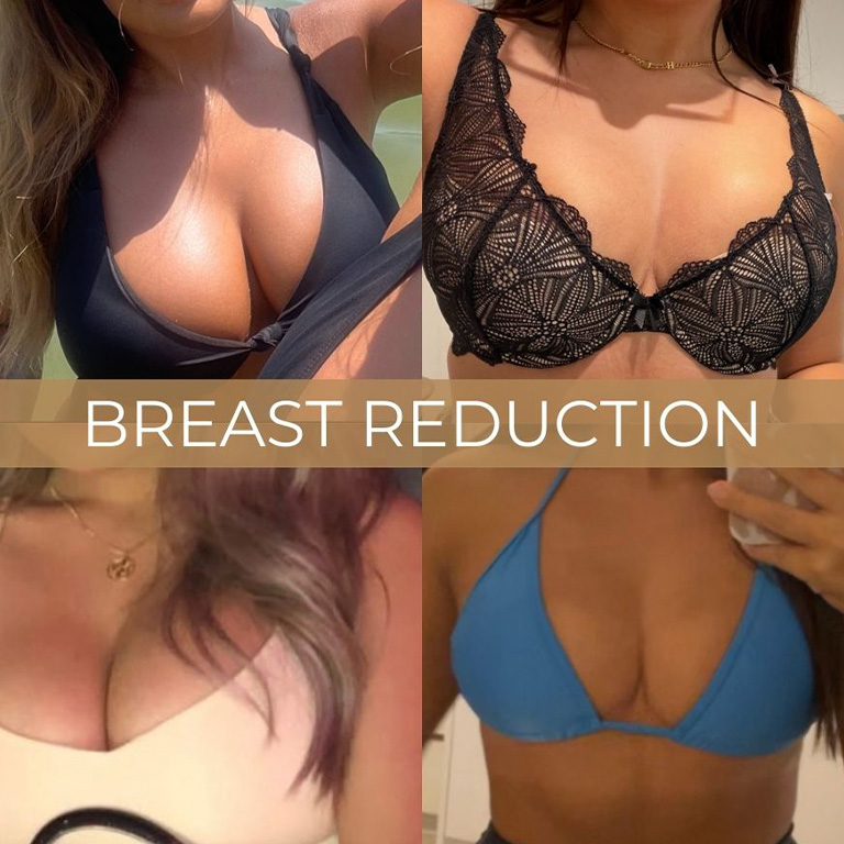 Breast Reduction Surgery (Mammaplasty)