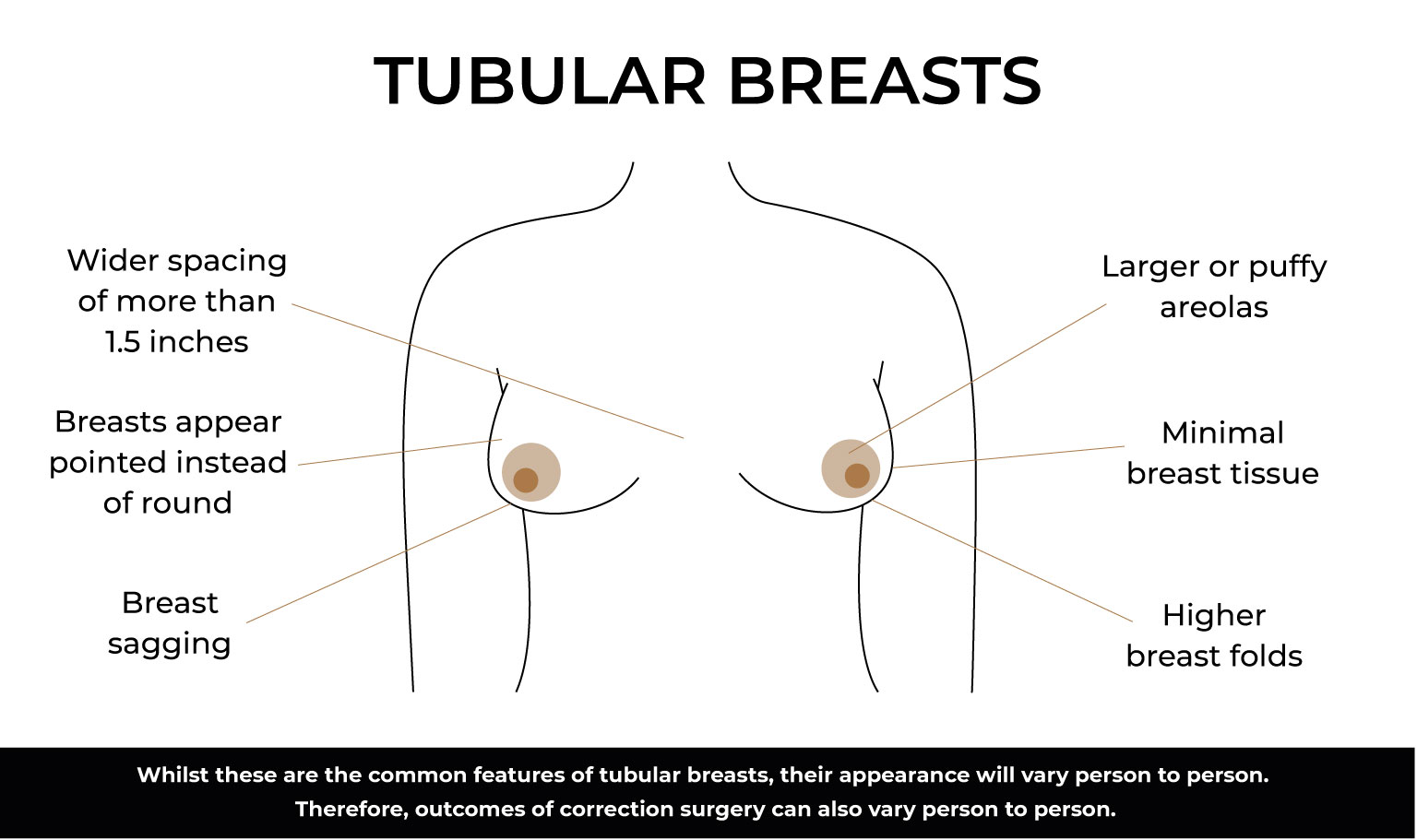 What do tubular breasts look like?