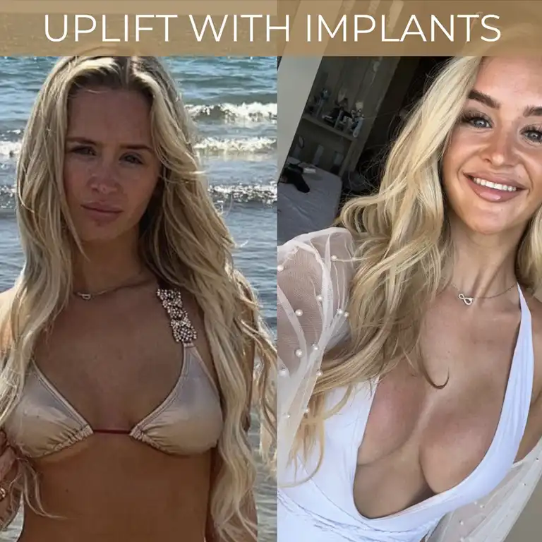Upflift with Implants