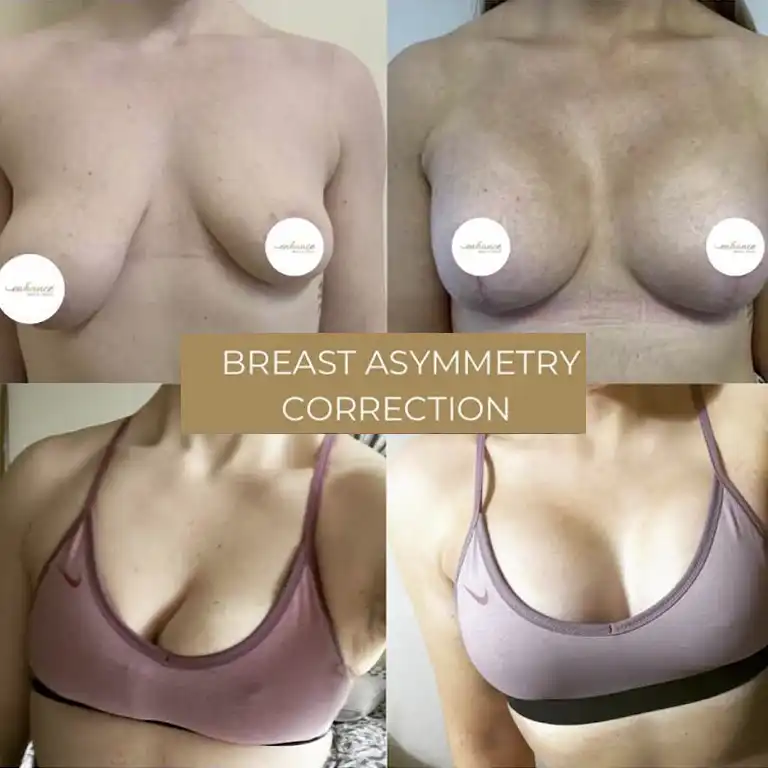 It's normal to have this kind of uneven boobs. How can I fix this