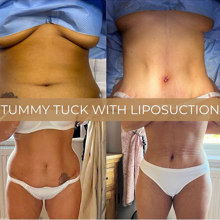 Tummy Tuck Surgery – Abdominoplasty