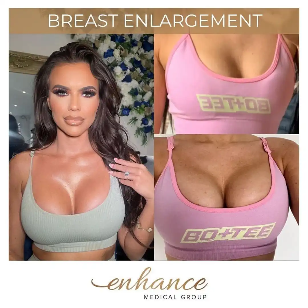 Breast Enlargement Birmingham Before and After