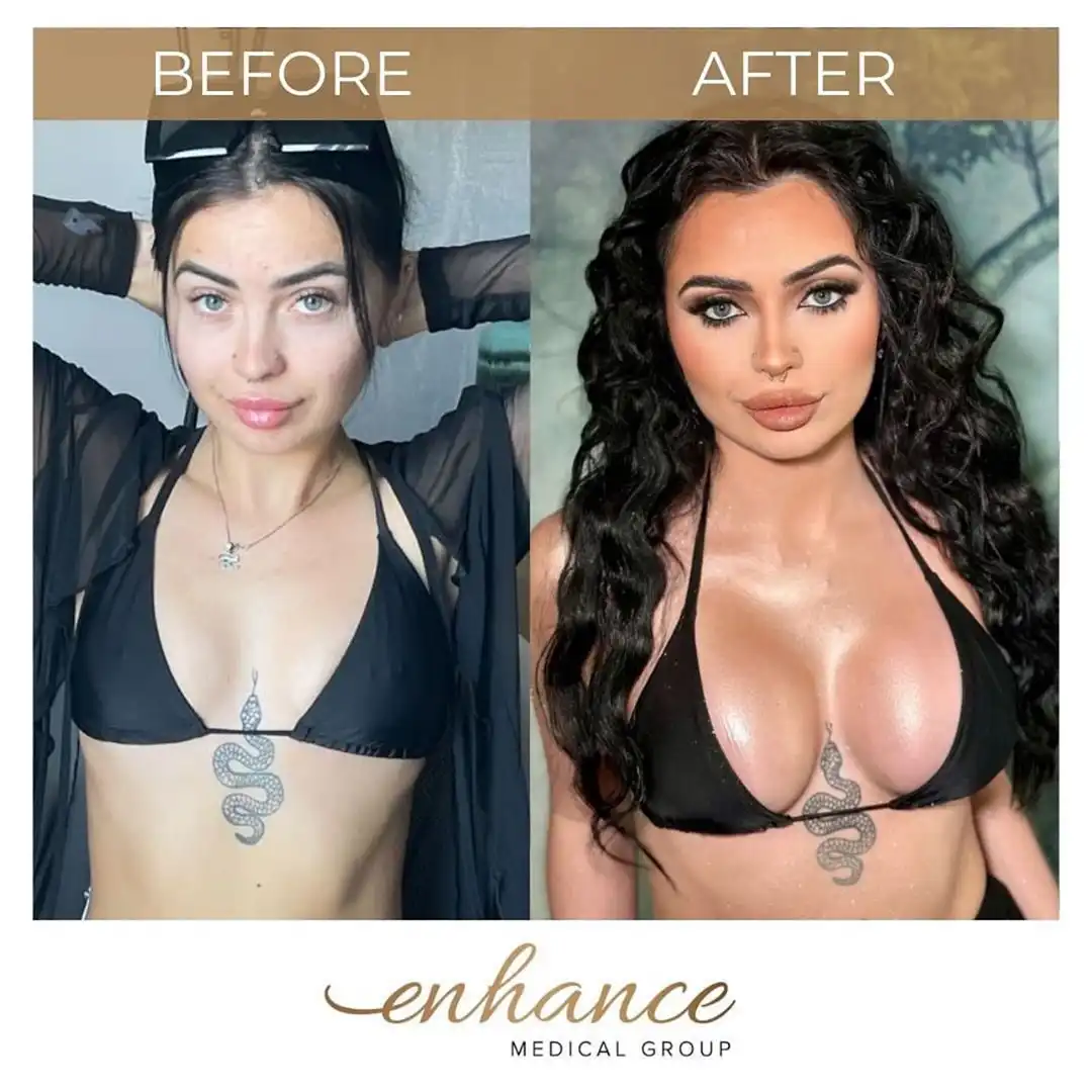 Breast Enlargement Birmingham Before and After
