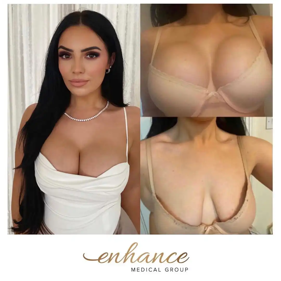 Breast Enlargement Birmingham Before and After
