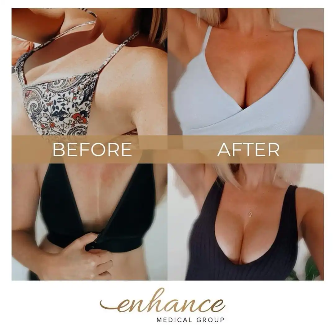 Breast Enlargement Birmingham Before and After