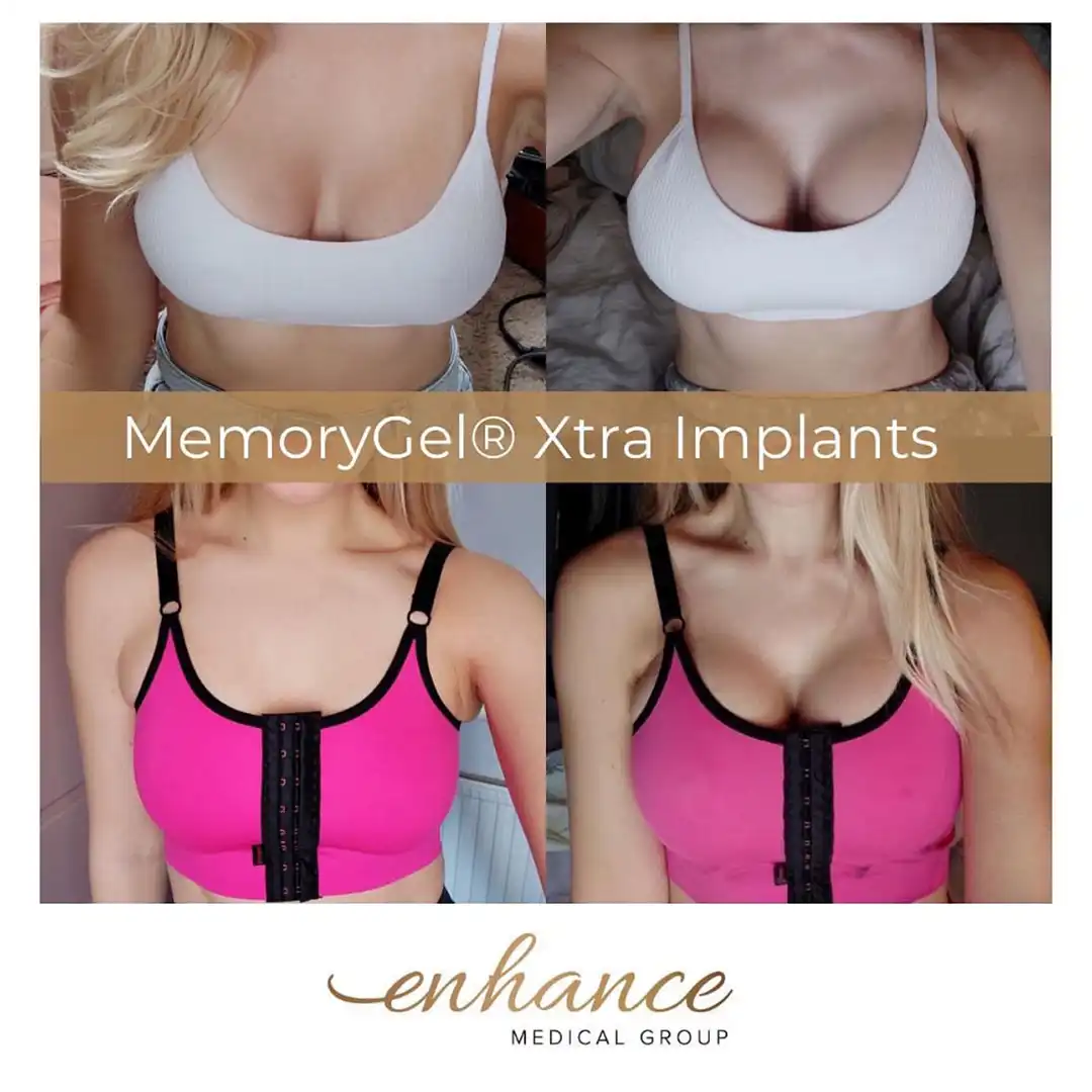 Breast Enlargement Birmingham Before and After