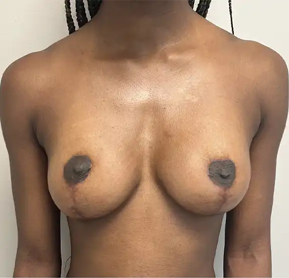 Before and After Mastopexy