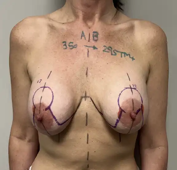 Reaugmentation Before and After