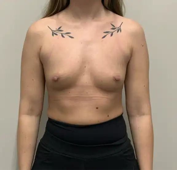 Breast Enlargement Before and After