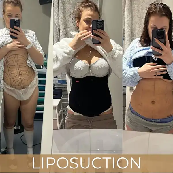 Is Liposuction Permanent?