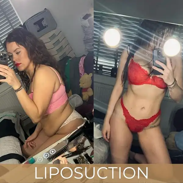 Liposuction Before and After