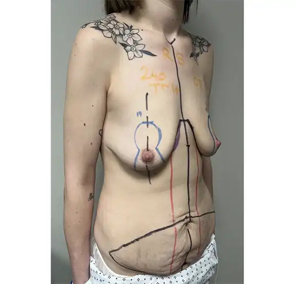 Body and Breast Surgical Procedure Before and After