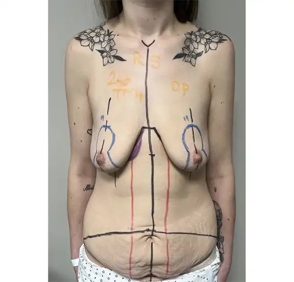 Body and Breast Surgical Procedure Before and After