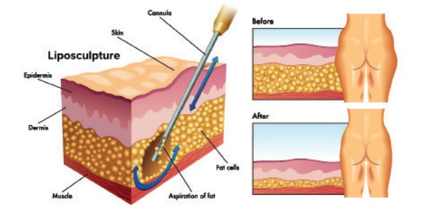 Comparing Different Liposuction Techniques: Traditional, VASER & Laser