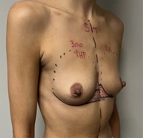 Breast Enlargement Before & Afters