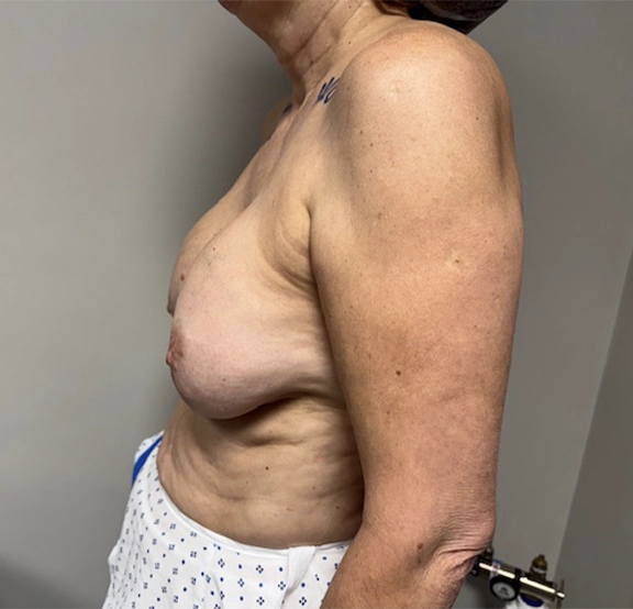 implant removal with mastopexy