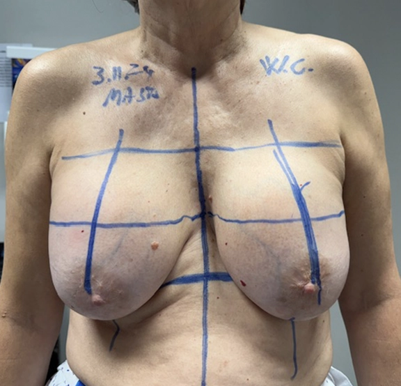 implant removal with mastopexy