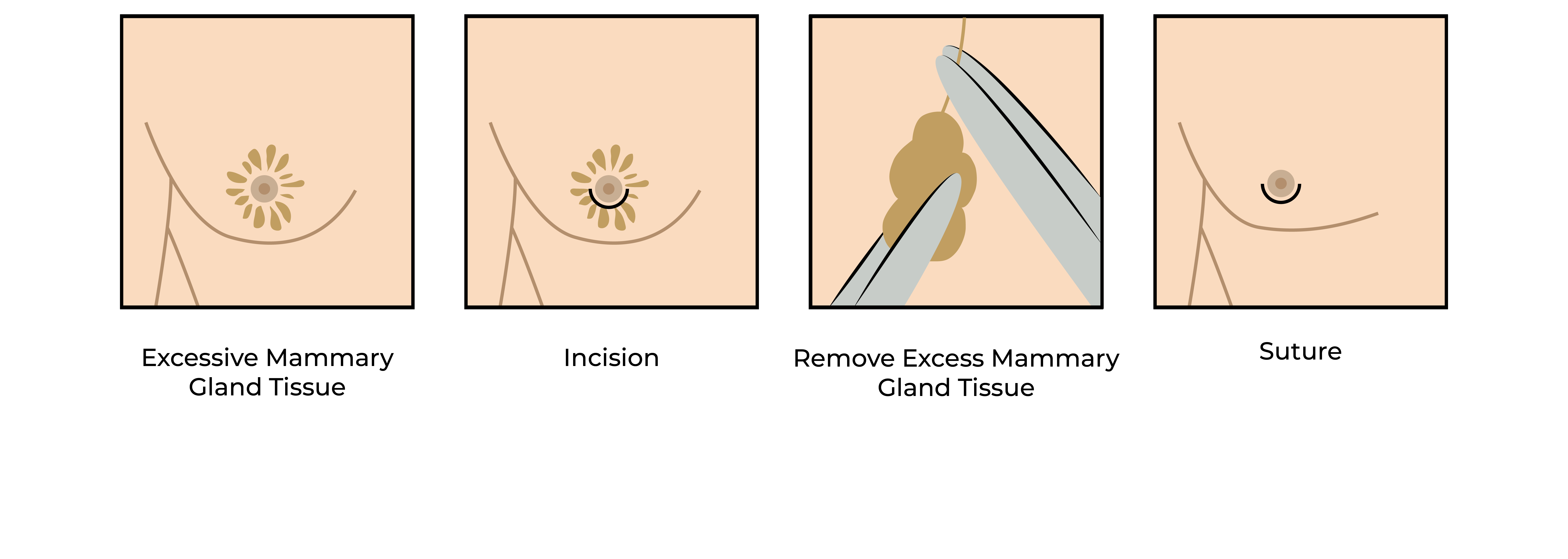 A four-step illustrated diagram showing the surgical procedure for gynecomastia (male breast reduction)