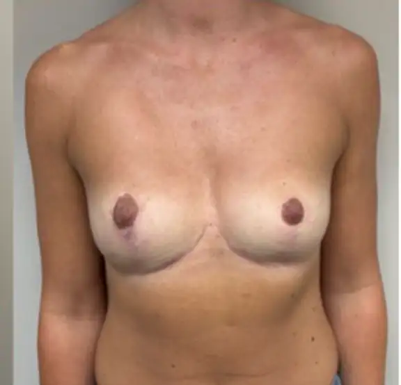 Implant Removal with Mastopexy