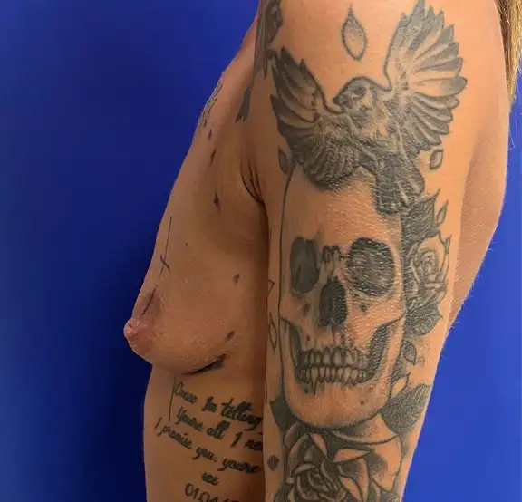 Breast enlargement with periareolar mastopexy 300cc round textured HP dual plane implants